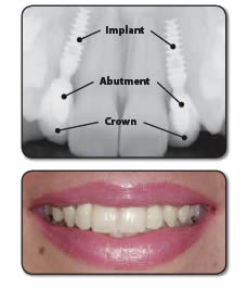 Bicon implants