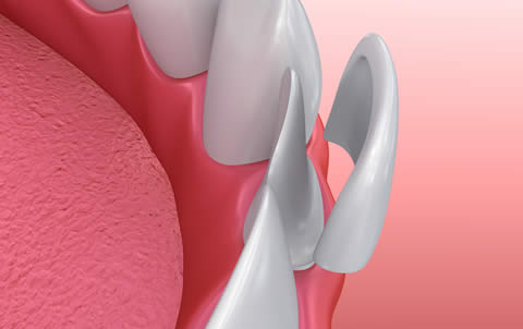 Dental veneers