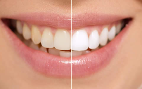 Teeth whitening